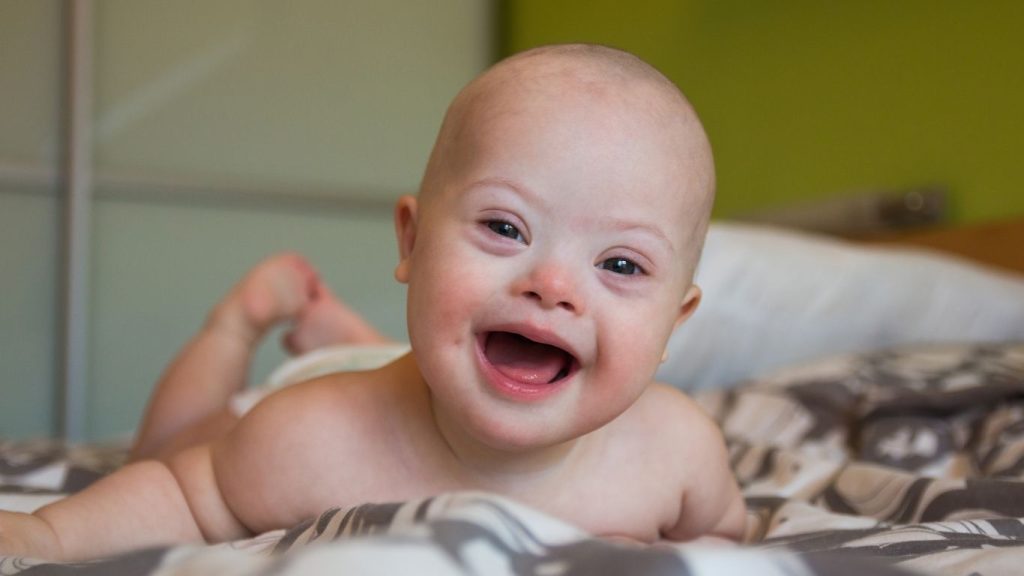 Image of a baby with Down Syndrome
